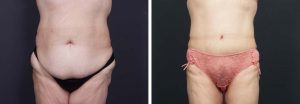 Body Lift Patient 1a | Dr. Shaun Parson Plastic Surgery Scottsdale Arizona