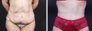 Body Lift Patient 2a | Dr. Shaun Parson Plastic Surgery Scottsdale Arizona