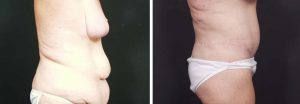 Body Lift Patient 4a | Dr. Shaun Parson Plastic Surgery Scottsdale Arizona