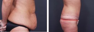 Body Lift Patient 5a | Dr. Shaun Parson Plastic Surgery Scottsdale Arizona