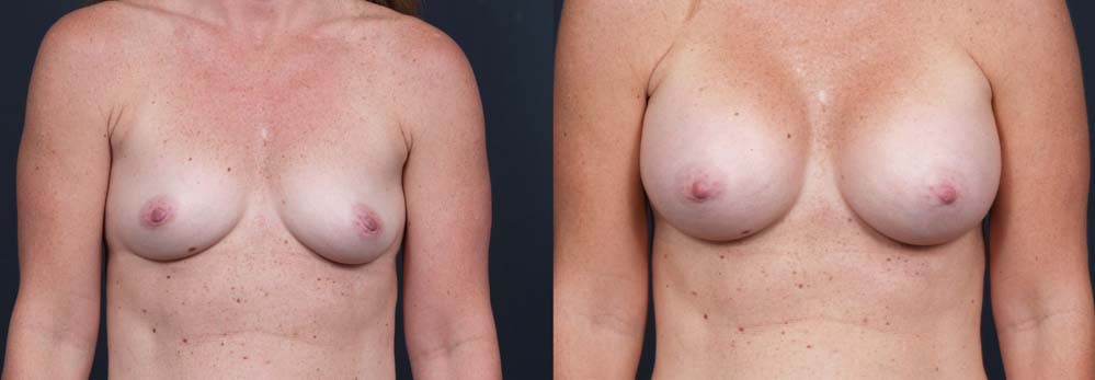 Breast Augmentation Patient 10a | Dr. Shaun Parson Plastic Surgery Scottsdale Arizona