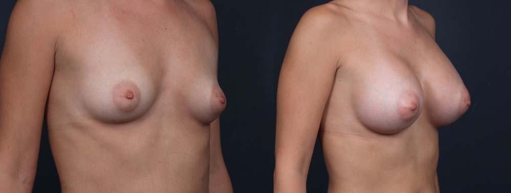 Breast Augmentation Patient 12a | Dr. Shaun Parson Plastic Surgery Scottsdale Arizona