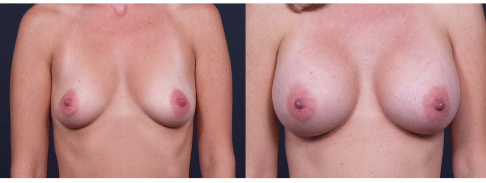 Breast Augmentation Patient 13b | Dr. Shaun Parson Plastic Surgery Scottsdale Arizona