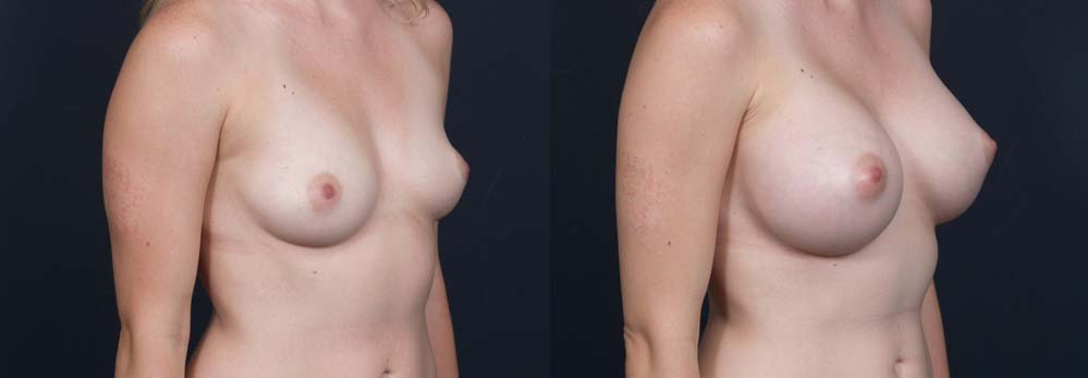 Breast Augmentation Patient 14a | Dr. Shaun Parson Plastic Surgery Scottsdale Arizona