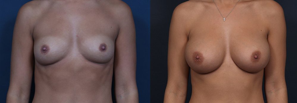 Breast Augmentation Patient 15a | Dr. Shaun Parson Plastic Surgery Scottsdale Arizona