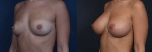 Breast Augmentation Patient 15a | Dr. Shaun Parson Plastic Surgery Scottsdale Arizona
