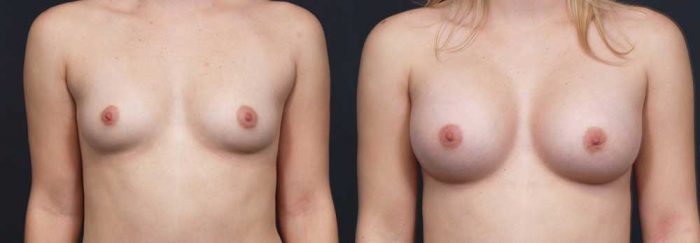 Breast Augmentation Patient 16a | Dr. Shaun Parson Plastic Surgery Scottsdale Arizona