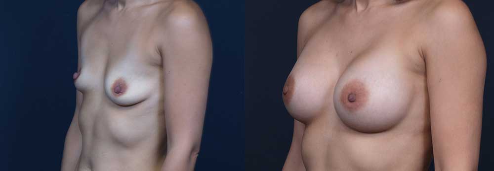 Breast Augmentation Patient 17 | Dr. Shaun Parson Plastic Surgery Scottsdale Arizona