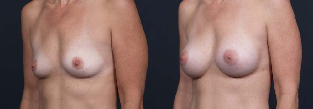 Breast Augmentation Patient 1a | Dr. Shaun Parson Plastic Surgery Scottsdale, Arizona