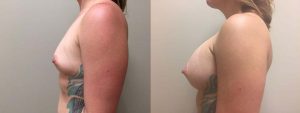 Breast Augmentation Patient 21b | Dr. Shaun Parson Plastic Surgery Scottsdale Arizona