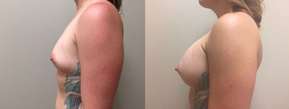 Breast Augmentation Patient 21b | Dr. Shaun Parson Plastic Surgery Scottsdale Arizona