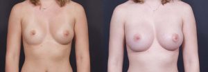 Breast Augmentation Patient 2a | Dr. Shaun Parson Plastic Surgery Scottsdale Arizona