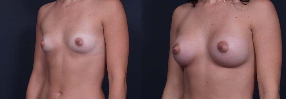 Breast Augmentation Patient 3a | Dr. Shaun Parson Plastic Surgery Scottsdale Arizona