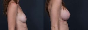 Breast Augmentation Patient 4b | Dr. Shaun Parson Plastic Surgery Scottsdale Arizona