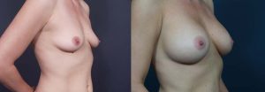 Breast Augmentation Patient 5a | Dr. Shaun Parson Plastic Surgery Scottsdale Arizona