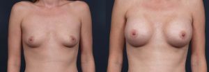 Breast Augmentation Patient 7b | Dr. Shaun Parson Plastic Surgery Scottsdale Arizona