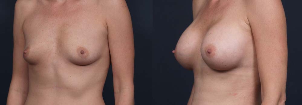 Breast Augmentation Patient 7b | Dr. Shaun Parson Plastic Surgery Scottsdale Arizona