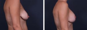 Breast Lift Aug Patient 12a | Dr. Shaun Parson Plastic Surgery Scottsdale Arizona