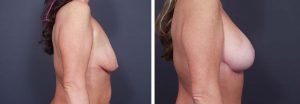 Breast Lift Peri Aug Patient 14 | Dr. Shaun Parson Plastic Surgery Scottsdale Arizona