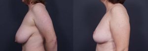 Breast Lift Patient 11 | Dr. Shaun Parson Plastic Surgery Scottsdale Arizona