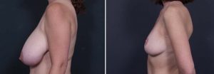 Breast Lift Patient 1a | Dr. Shaun Parson Plastic Surgery Scottsdale Arizona