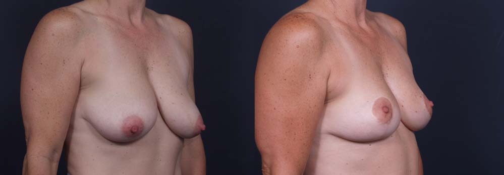Breast Lift Patient 3a | Dr. Shaun Parson Plastic Surgery Scottsdale Arizona