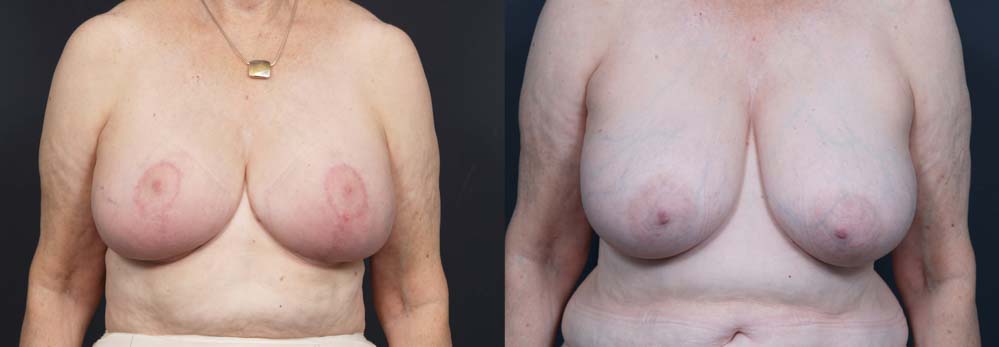 Breast Lift Patient 4a | Dr. Shaun Parson Plastic Surgery Scottsdale Arizona