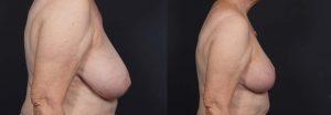 Breast Lift Patient 4a | Dr. Shaun Parson Plastic Surgery Scottsdale Arizona
