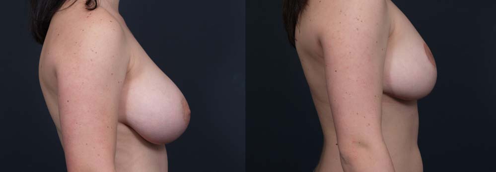 Breast Lift Patient 5 | Dr. Shaun Parson Plastic Surgery Scottsdale Arizona