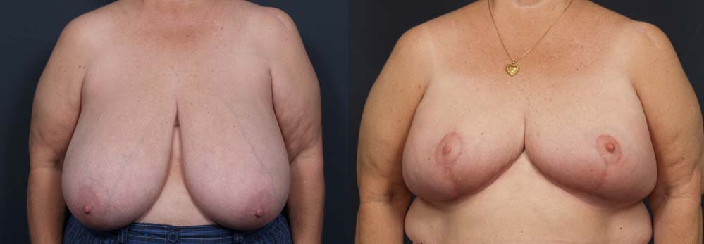 Breast Lift Patient 6 | Dr. Shaun Parson Plastic Surgery Scottsdale Arizona