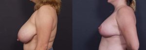 Breast Lift Patient 8a | Dr. Shaun Parson Plastic Surgery Scottsdale Arizona