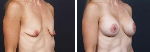 Breast Lift with Peri-Areolar Augmentation Patient 25 | Dr. Shaun Parson Plastic Surgery Scottsdale Arizona