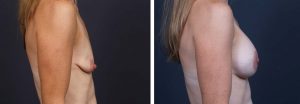 Breast Lift Peri Aug Patient 25 | Dr. Shaun Parson Plastic Surgery Scottsdale Arizona