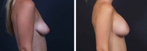 Breast Lift Peri Aug Patient 29a | Dr. Shaun Parson Plastic Surgery Scottsdale Arizona