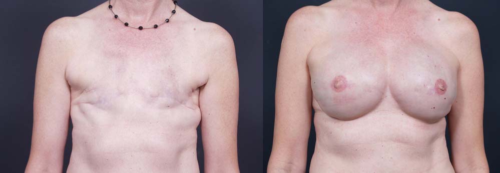 Breast Reconstruction Patient 5 | Dr. Shaun Parson Plastic Surgery Scottsdale Arizona