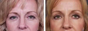Brow Lift Patient 1 | Dr. Shaun Parson Plastic Surgery Scottsdale Arizona