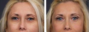 Brow Lift Patient 2 | Dr. Shaun Parson Plastic Surgery Scottsdale Arizona
