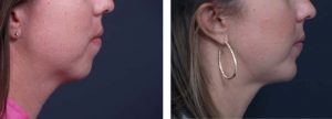Chin Aug Patient 3 | Dr. Shaun Parson Plastic Surgery Scottsdale Arizona