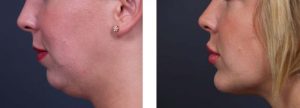 Chin Aug Patient 4 | Dr. Shaun Parson Plastic Surgery Scottsdale Arizona