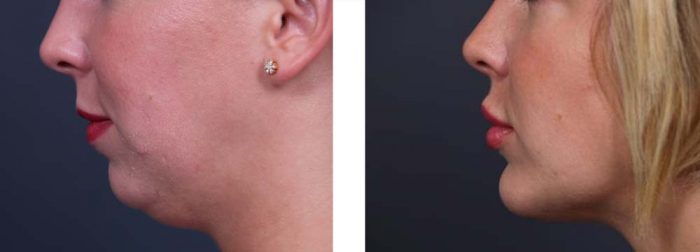 Chin Aug Patient 4 | Dr. Shaun Parson Plastic Surgery Scottsdale Arizona
