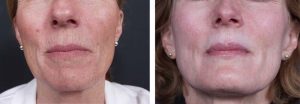 Dermabrasion Patient 1 | Dr. Shaun Parson Plastic Surgery Scottsdale Arizona