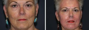 Dermabrasion Patient 2a | Dr. Shaun Parson Plastic Surgery Scottsdale Arizona