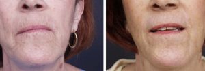 Dermabrasion Patient 3 | Dr. Shaun Parson Plastic Surgery Scottsdale Arizona