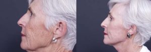 Facelift Patient 1a | Dr. Shaun Parson Plastic Surgery Scottsdale Arizona