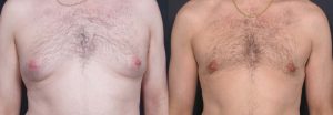 Gynecomastia Patient 2a | Dr. Shaun Parson Plastic Surgery Scottsdale Arizona