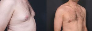 Gynecomastia Patient 2a | Dr. Shaun Parson Plastic Surgery Scottsdale Arizona