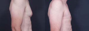 Gynecomastia Patient 3a | Dr. Shaun Parson Plastic Surgery Scottsdale Arizona