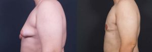 Gynecomastia Patient 4a | Dr. Shaun Parson Plastic Surgery Scottsdale Arizona