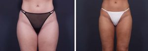 Liposuction Patient 3a | Dr. Shaun Parson Plastic Surgery Scottsdale Arizona