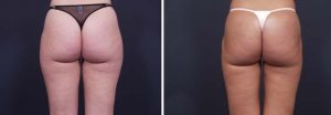 Liposuction Patient 3a | Dr. Shaun Parson Plastic Surgery Scottsdale Arizona